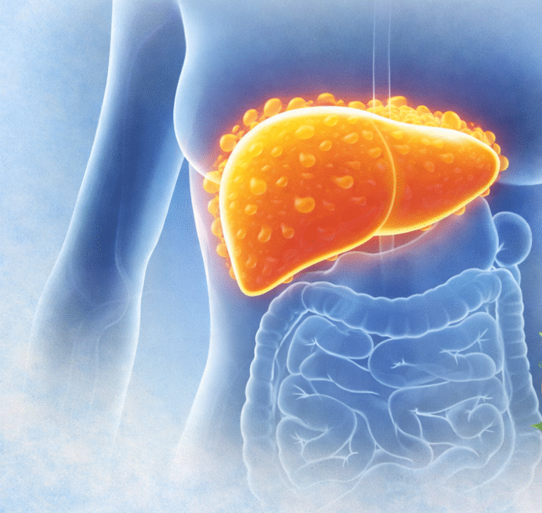 Esteatose hepática: quando a gordura se acumula no fígado