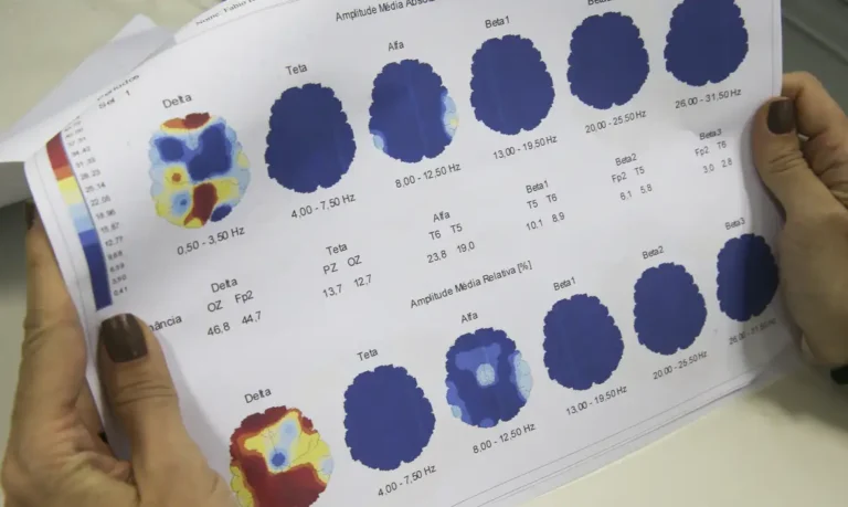 Epilepsia: condição demanda tratamento por toda a vida