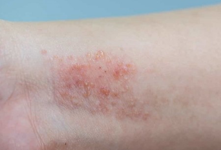 Dermatite atópica: causas, sintomas e tratamento