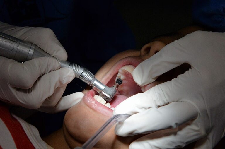 Anvisa alerta sobre riscos de tratamentos odontológicos caseiros e recomenda orientação profissional